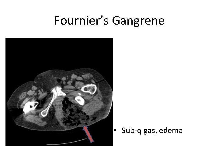Fournier’s Gangrene • Sub-q gas, edema 