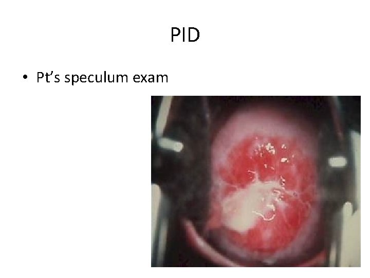 PID • Pt’s speculum exam 
