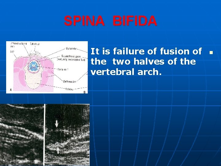 SPINA BIFIDA It is failure of fusion of the two halves of the vertebral