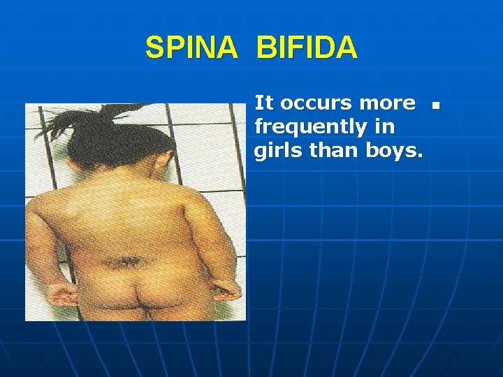 SPINA BIFIDA It occurs more frequently in girls than boys. n 