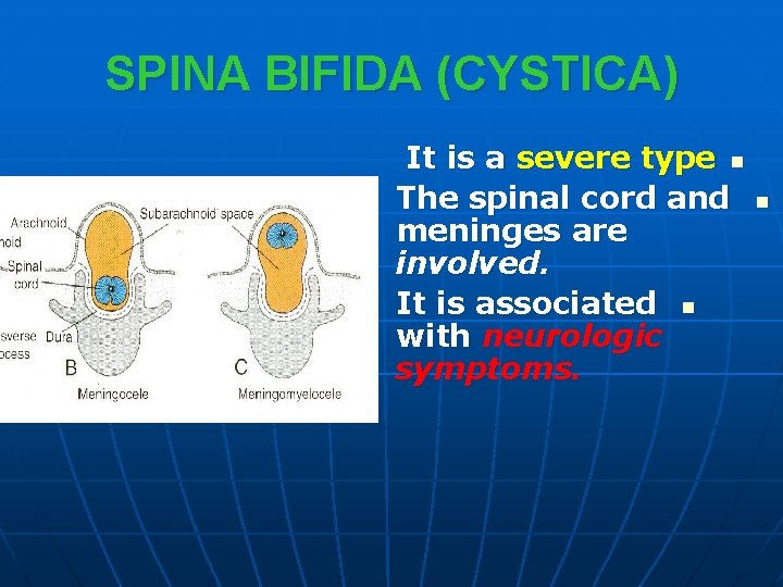 SPINA BIFIDA (CYSTICA) It is a severe type n The spinal cord and meninges