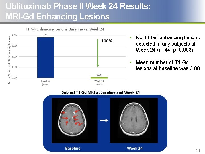 Ublituximab Phase II Week 24 Results: MRI-Gd Enhancing Lesions § No T 1 Gd-enhancing
