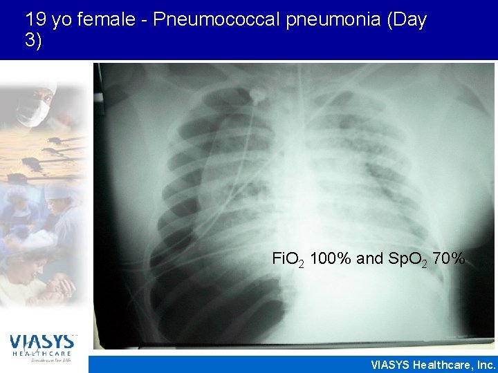 19 yo female - Pneumococcal pneumonia (Day 3) Fi. O 2 100% and Sp.
