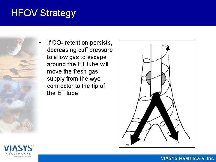 HFOV Strategy • If CO 2 retention persists, decreasing cuff pressure to allow gas