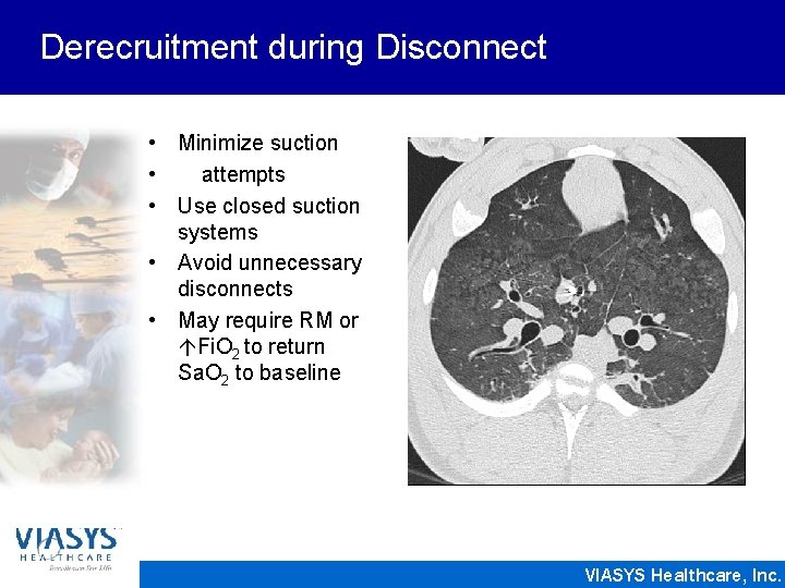 Derecruitment during Disconnect • Minimize suction • attempts • Use closed suction systems •