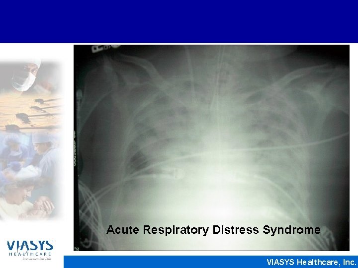 Acute Respiratory Distress Syndrome VIASYS Healthcare, Inc. 