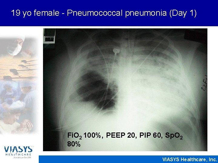 19 yo female - Pneumococcal pneumonia (Day 1) Fi. O 2 100%, PEEP 20,