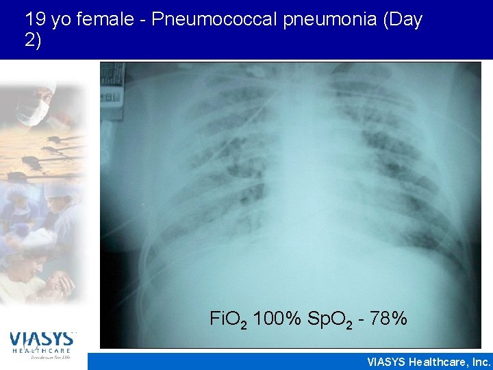 19 yo female - Pneumococcal pneumonia (Day 2) Fi. O 2 100% Sp. O