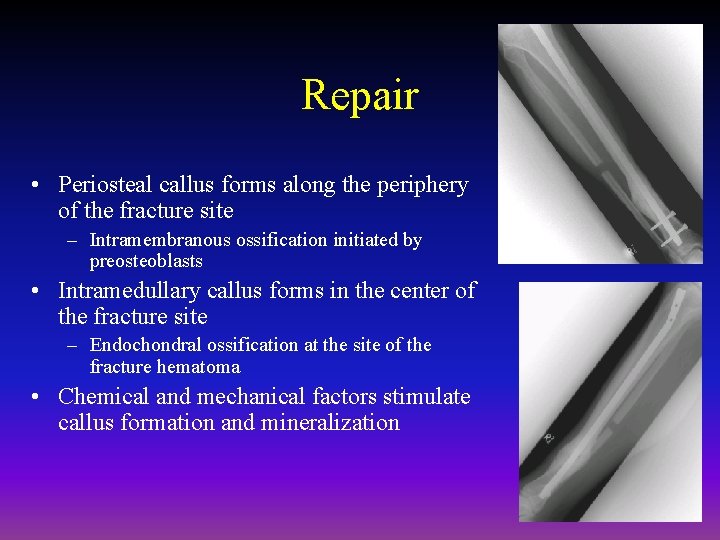 Repair • Periosteal callus forms along the periphery of the fracture site – Intramembranous