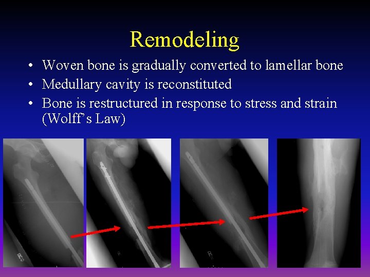 Remodeling • Woven bone is gradually converted to lamellar bone • Medullary cavity is