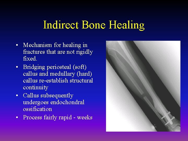 Indirect Bone Healing • Mechanism for healing in fractures that are not rigidly fixed.