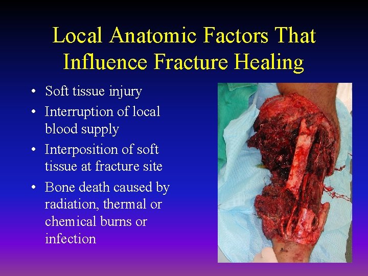 Local Anatomic Factors That Influence Fracture Healing • Soft tissue injury • Interruption of