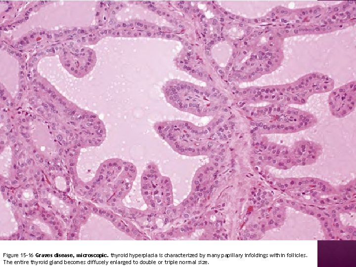 Figure 15 -16 Graves disease, microscopic. thyroid hyperplasia is characterized by many papillary infoldings