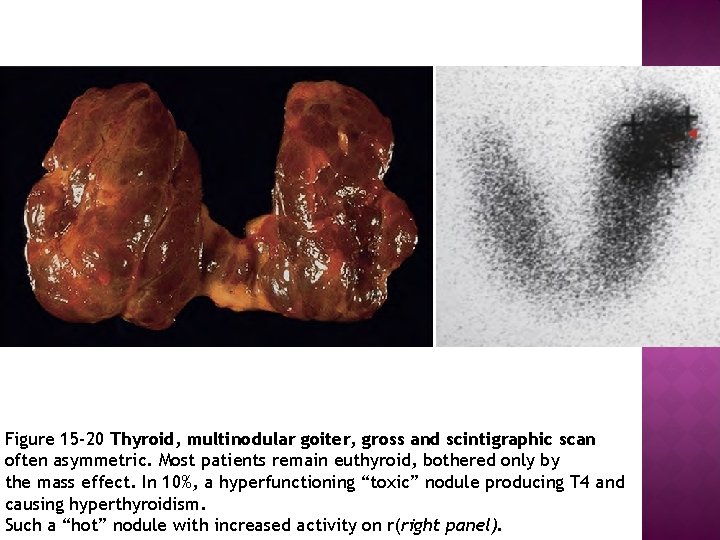 Figure 15 -20 Thyroid, multinodular goiter, gross and scintigraphic scan often asymmetric. Most patients