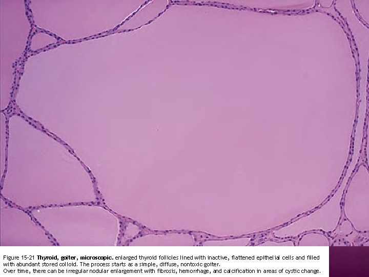 Figure 15 -21 Thyroid, goiter, microscopic. enlarged thyroid follicles lined with inactive, flattened epithelial