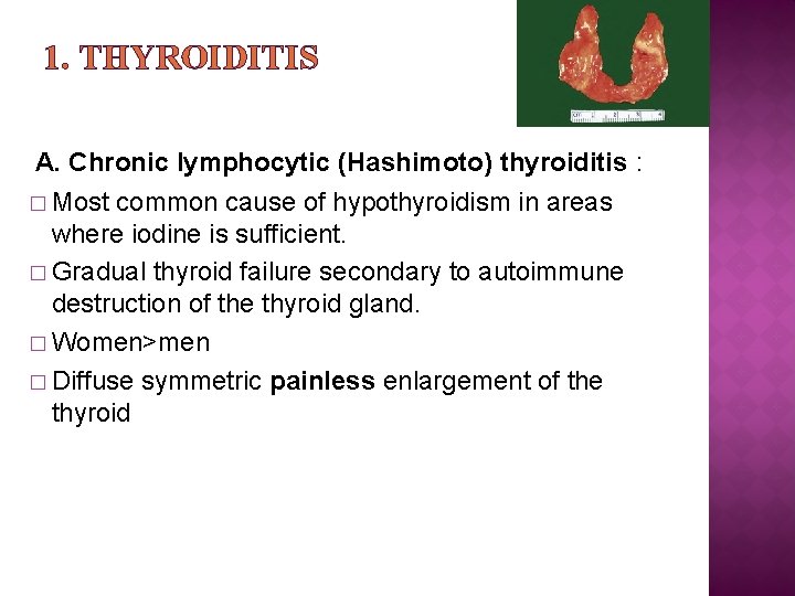 1. THYROIDITIS A. Chronic lymphocytic (Hashimoto) thyroiditis : � Most common cause of hypothyroidism