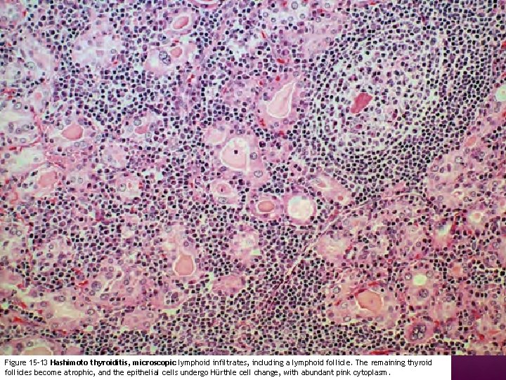 Figure 15 -13 Hashimoto thyroiditis, microscopic lymphoid infiltrates, including a lymphoid follicle. The remaining