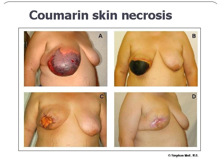 Coumarin skin necrosis 
