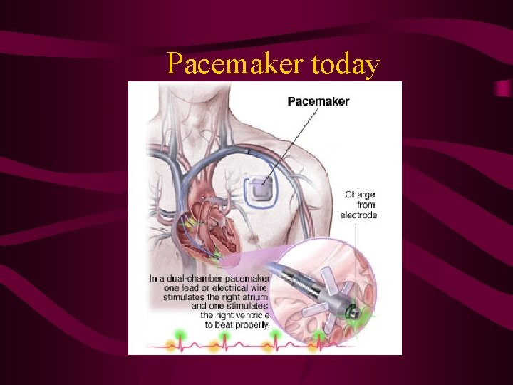 Pacemaker today 