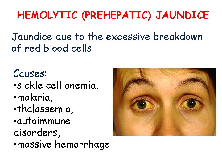 HEMOLYTIC (PREHEPATIC) JAUNDICE Jaundice due to the excessive breakdown of red blood cells. Causes: