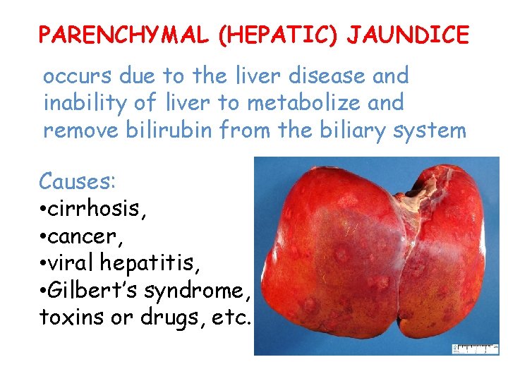 PARENCHYMAL (HEPATIC) JAUNDICE occurs due to the liver disease and inability of liver to