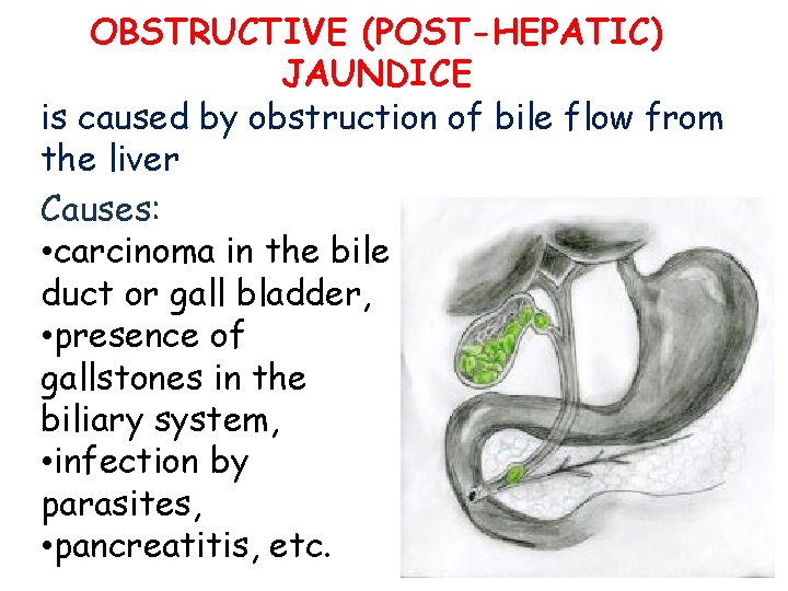 ОBSTRUCTIVE (POST-HEPATIC) JAUNDICE is caused by obstruction of bile flow from the liver Causes: