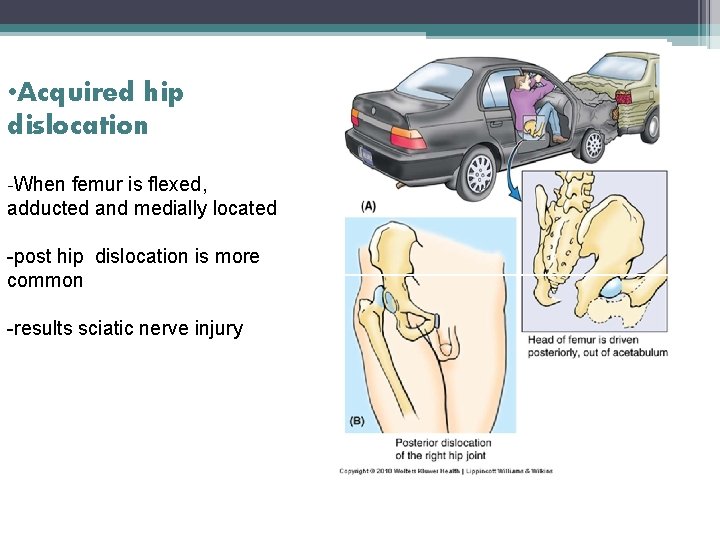  • Acquired hip dislocation -When femur is flexed, adducted and medially located -post