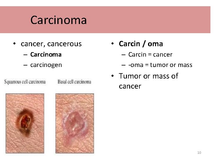 Carcinoma • cancer, cancerous – Carcinoma – carcinogen • Carcin / oma – Carcin