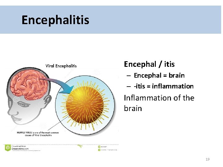 Encephalitis • Encephal / itis – Encephal = brain – -itis = inflammation •
