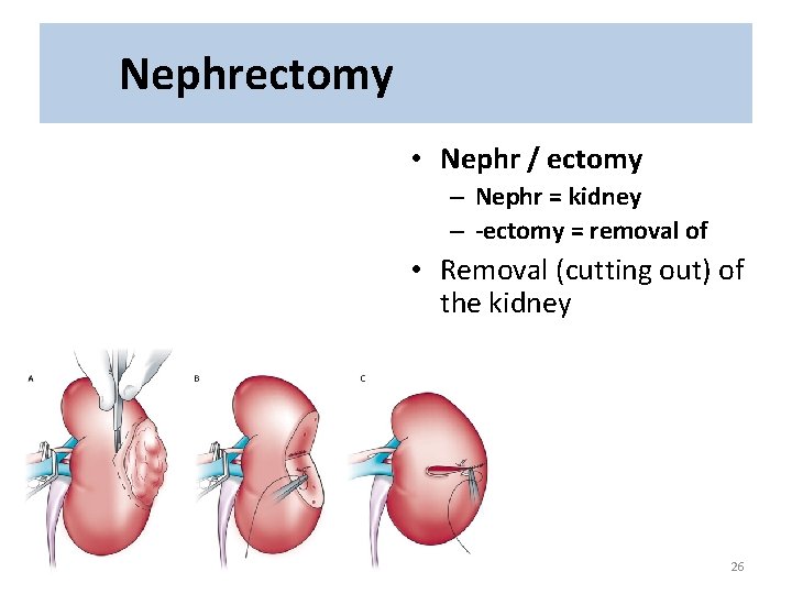 Nephrectomy • Nephr / ectomy – Nephr = kidney – -ectomy = removal of