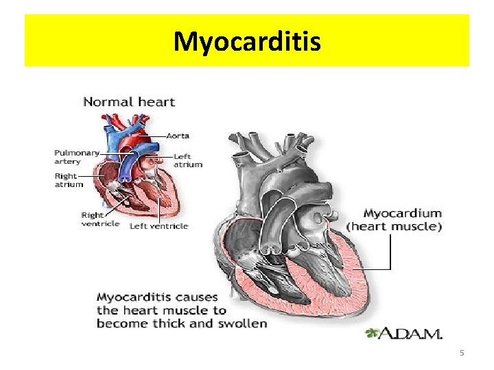 Myocarditis 5 