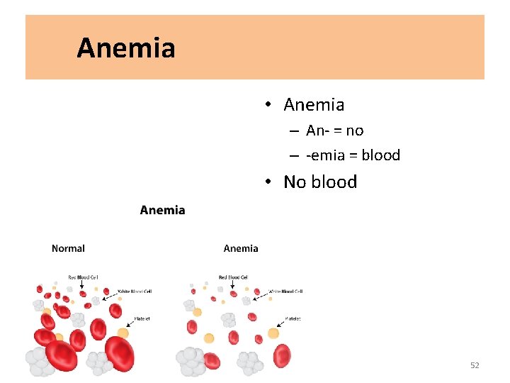 Anemia • Anemia – An- = no – -emia = blood • No blood