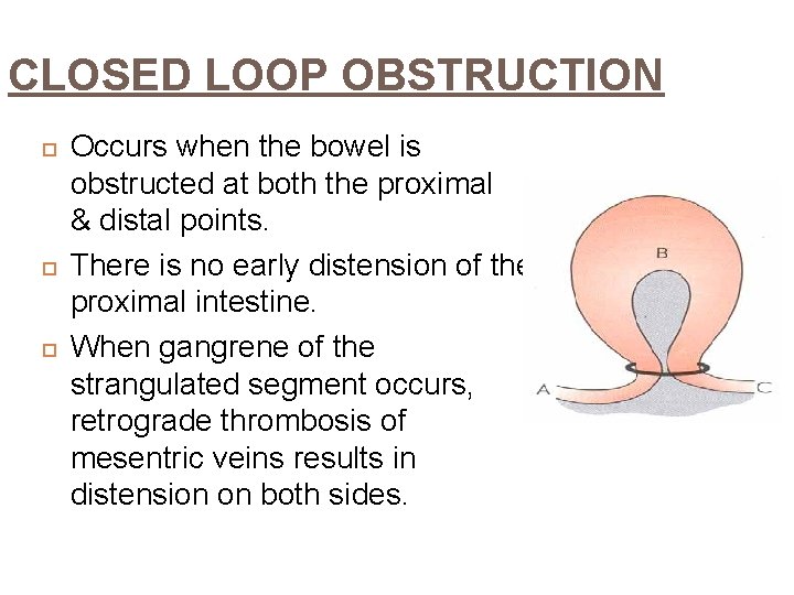 CLOSED LOOP OBSTRUCTION Occurs when the bowel is obstructed at both the proximal &