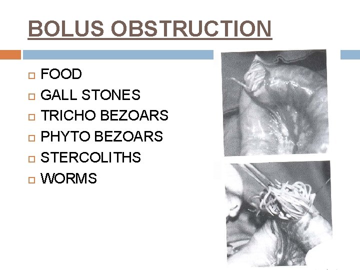 BOLUS OBSTRUCTION FOOD GALL STONES TRICHO BEZOARS PHYTO BEZOARS STERCOLITHS WORMS 