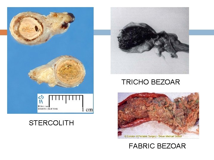 TRICHO BEZOAR STERCOLITH FABRIC BEZOAR 