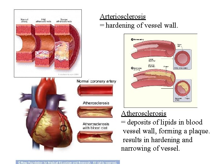 Arteriosclerosis = hardening of vessel wall. Atherosclerosis = deposits of lipids in blood vessel