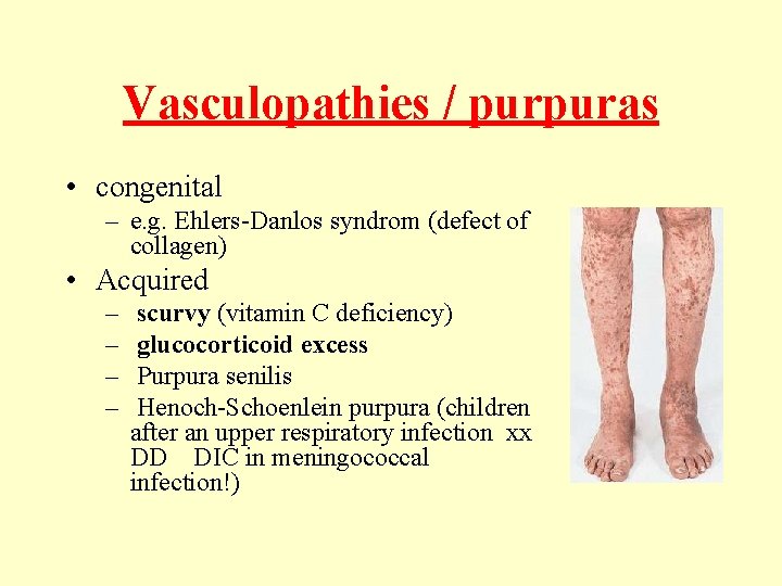 Vasculopathies / purpuras • congenital – e. g. Ehlers-Danlos syndrom (defect of collagen) •