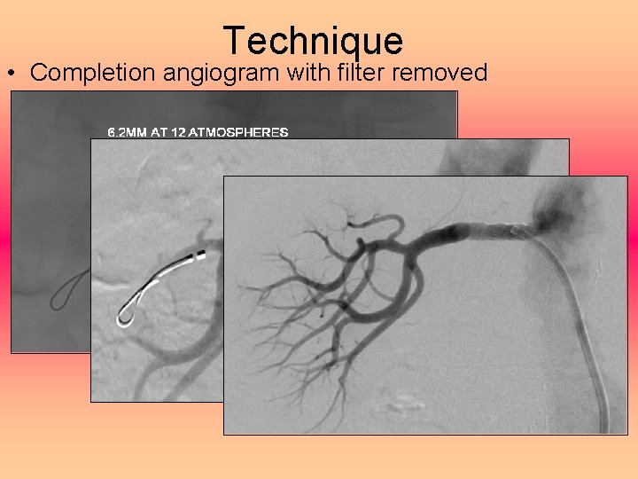Technique • Completion angiogram with filter removed 