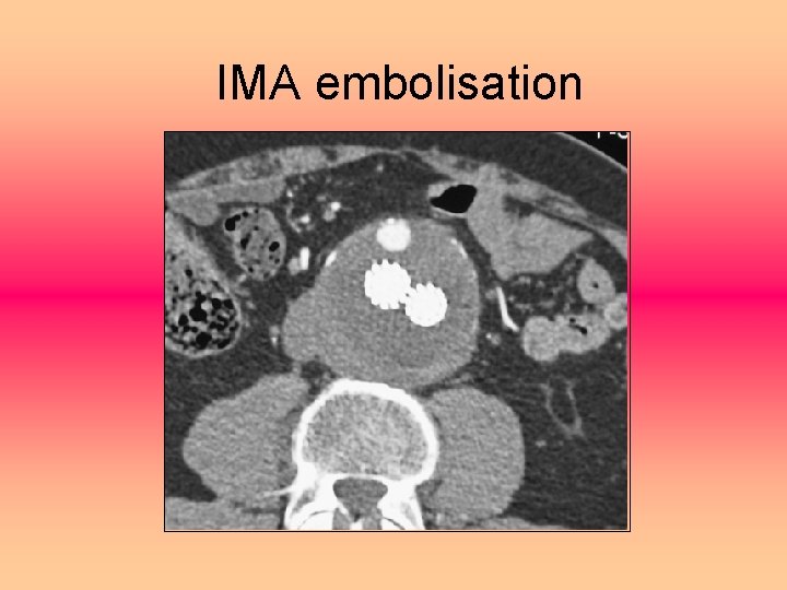 IMA embolisation 