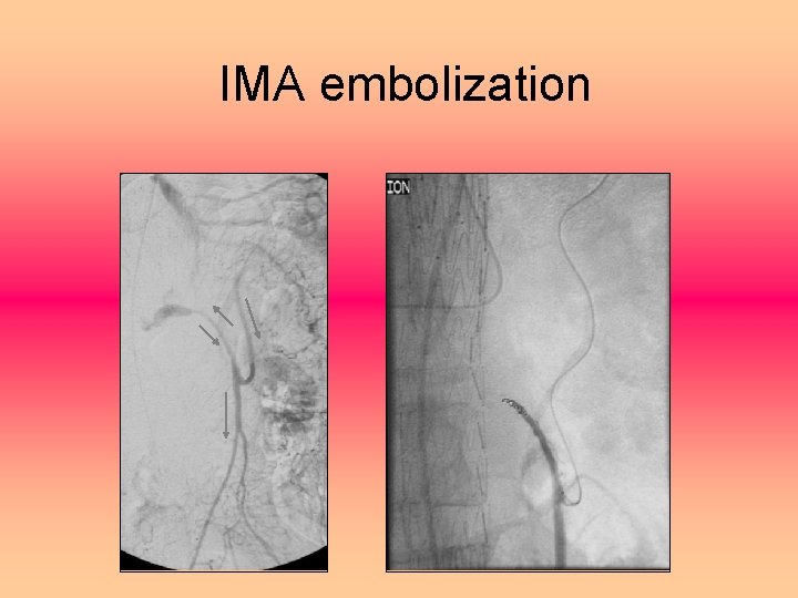 IMA embolization 