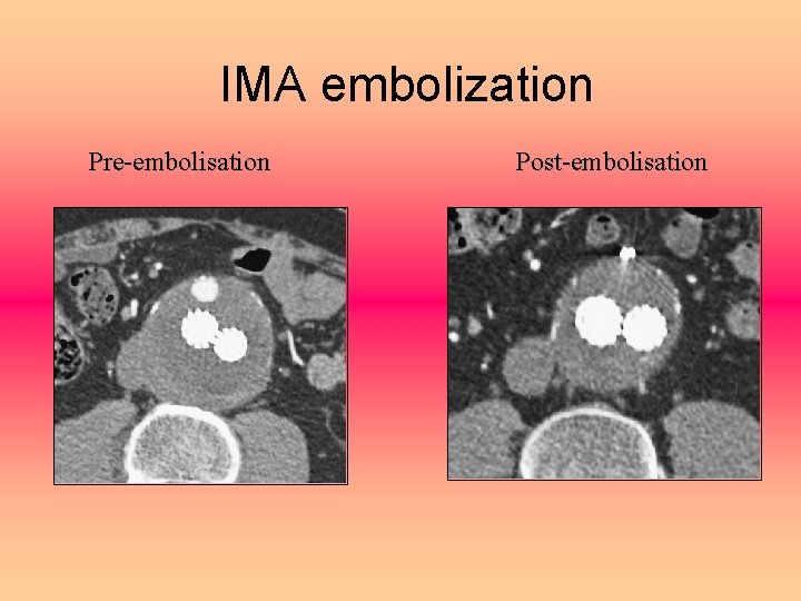 IMA embolization Pre-embolisation Post-embolisation 
