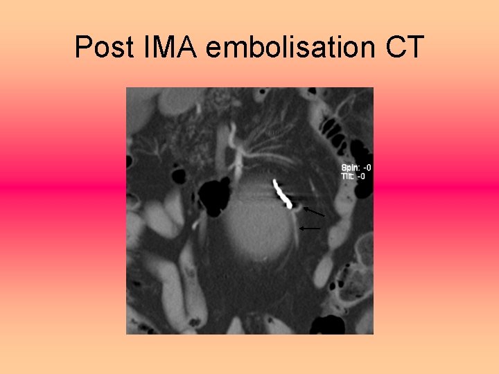 Post IMA embolisation CT 