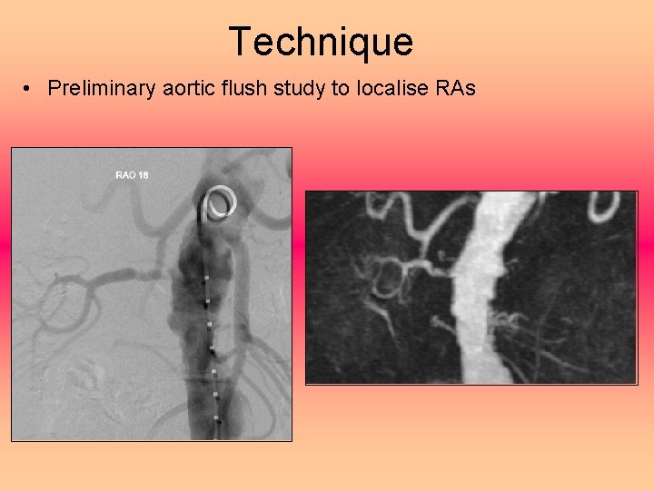 Technique • Preliminary aortic flush study to localise RAs 
