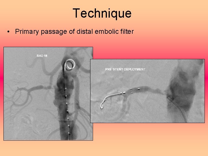 Technique • Primary passage of distal embolic filter 
