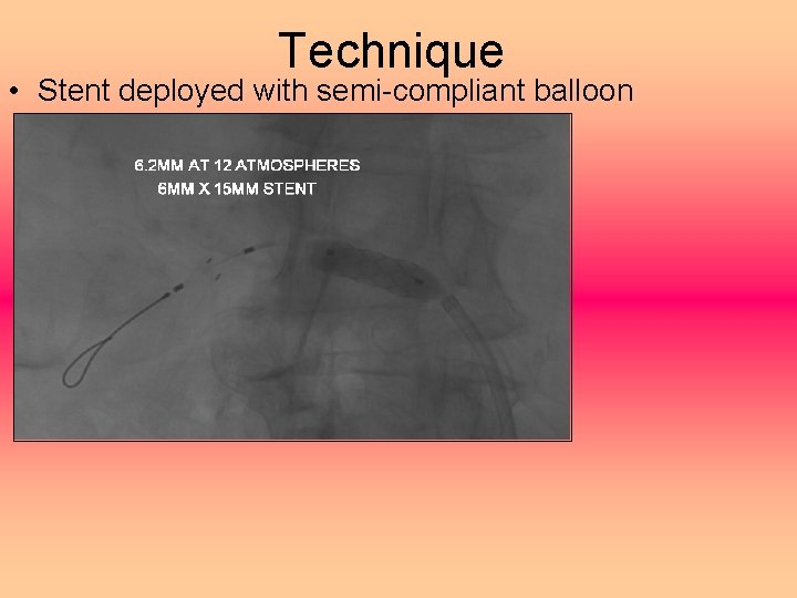 Technique • Stent deployed with semi-compliant balloon 
