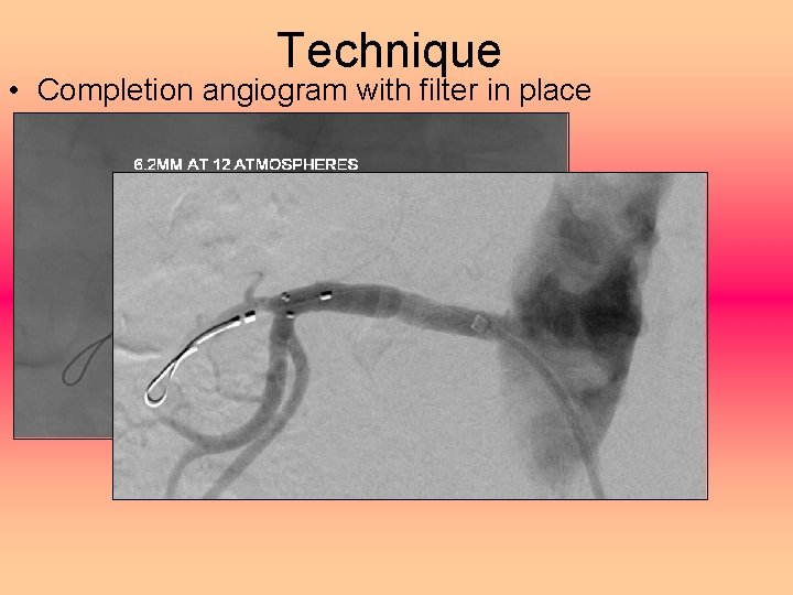 Technique • Completion angiogram with filter in place 