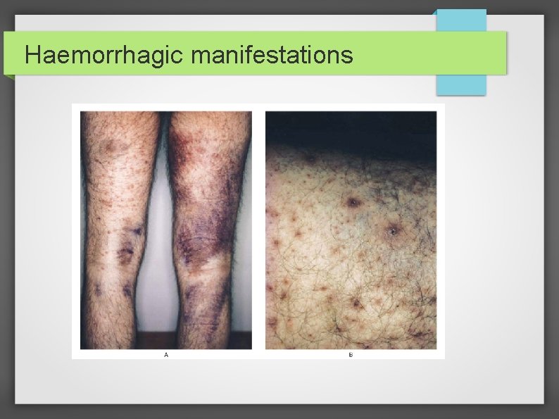 Haemorrhagic manifestations 