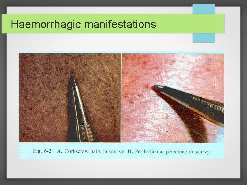 Haemorrhagic manifestations 