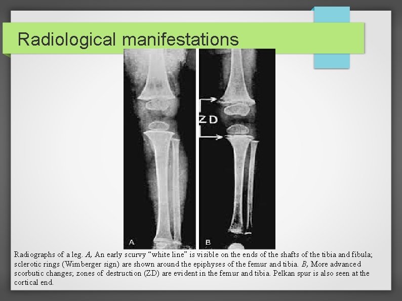 Radiological manifestations Radiographs of a leg. A, An early scurvy “white line” is visible