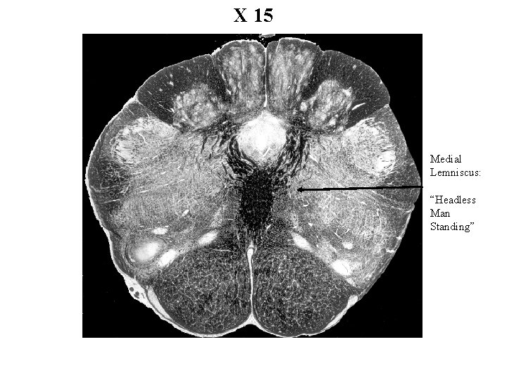 X 15 Medial Lemniscus: “Headless Man Standing” 